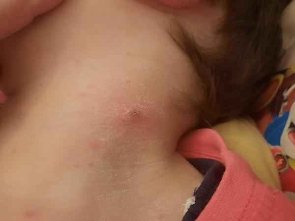 Ako zmierniť červené vyrážky pri kiahňach?