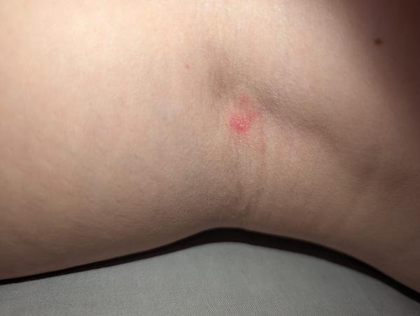 Je toto pásový opar počas tehotenstva?