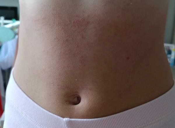 Aký kožný problém môže mať dcéra?