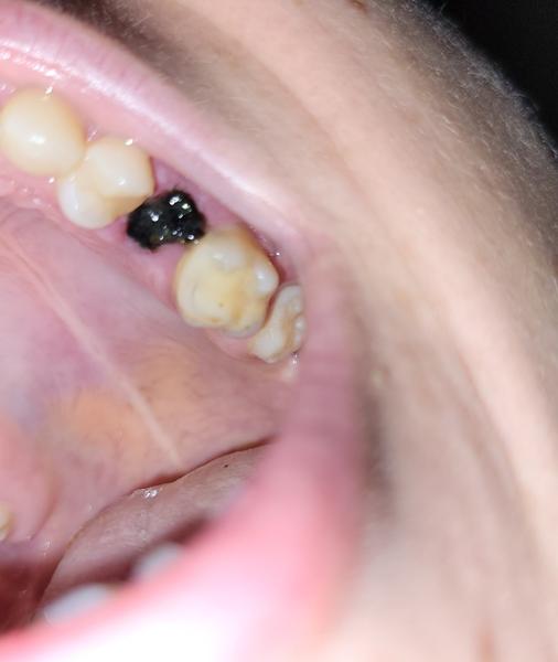 Čierny fľak po vytrhnuti zubu