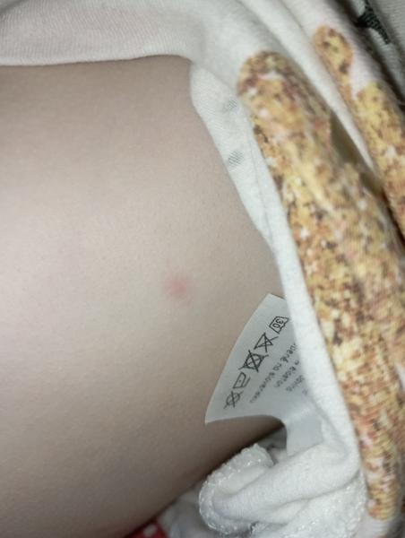 Z čoho sa vytvorili dcérke takéto svrbivé vyrážky?