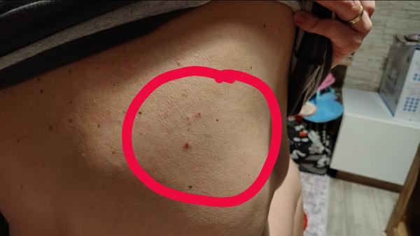 Je to znamienko alebo vyrážka?