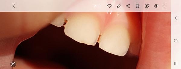 Štvorročná dcérka má odlomený kúsok z hornej jednotky. Je nutná návšteva zubára?