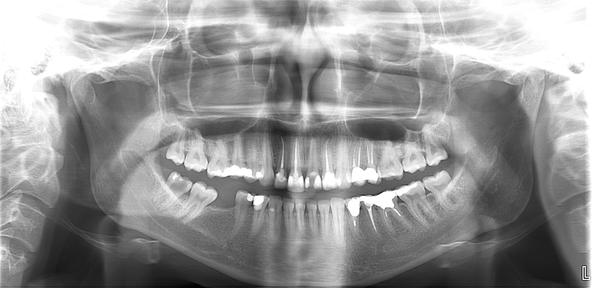 Pomoc s rozborom zubného röntgenového snímku