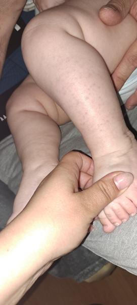 Fialové bodky pod kožou: Čo môžu znamenať?