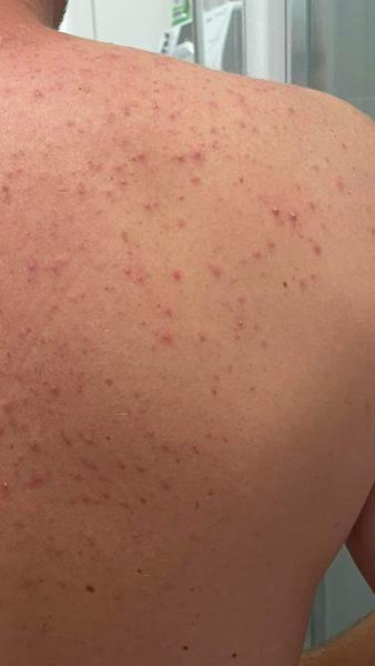 Z čoho môže byť tento výsyp na tvári a chrbte?