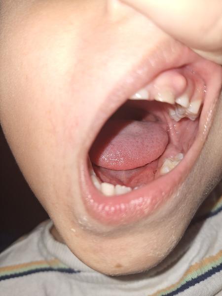 Hrčka na ďasne u dieťaťa