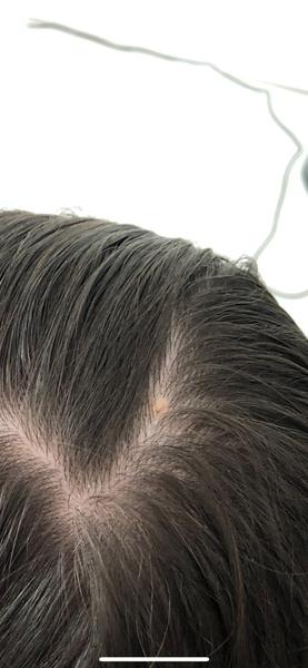 Mám to vo vlasoch šošovicu alebo bradavicu?