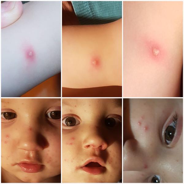 Má moja 15 mesačná dcérka kiahne?