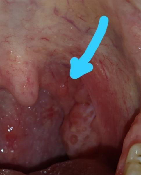 Je v poriadku, keď mám výrastok v ústnej dutine?