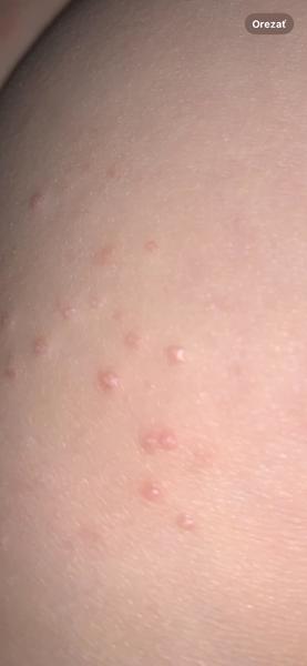 Kožné problémy u 5-ročnej: Čo to môže byť?