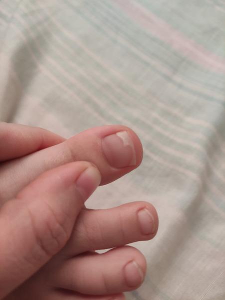 Ako riešiť necht u dieťaťa po úraze?