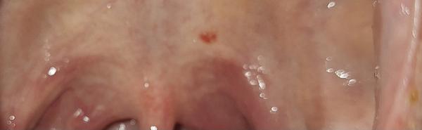 Čo znamená červený fľak na podnebí?