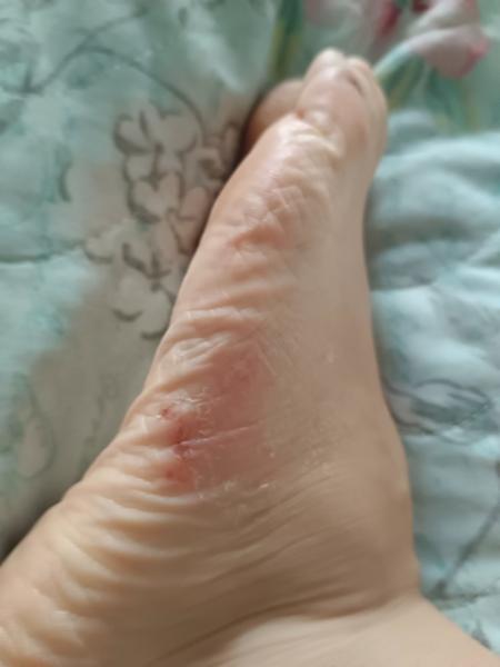 Čo spôsobuje fľaky na nohe?