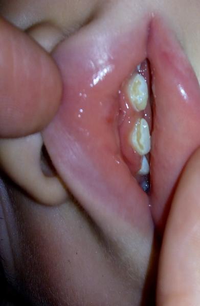 Dvojročný syn si nechce čistiť zúbky