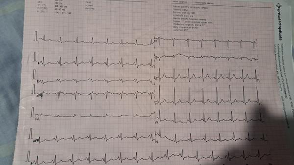 Je v popise EKG všetko pravda?