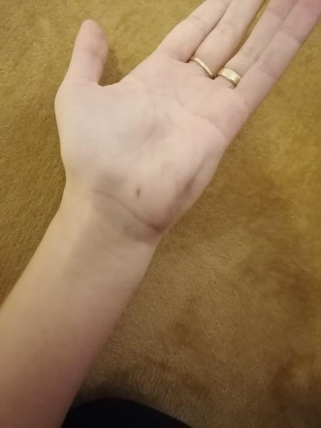 Pichla som sa a sčernela mi ruka