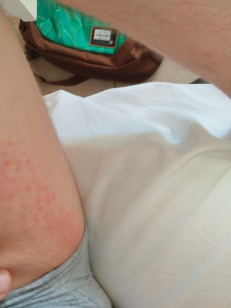 Ako liečiť vyrážky po kúpaní?