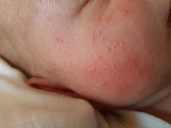 Vyrážky u trojtýždňového bábätka