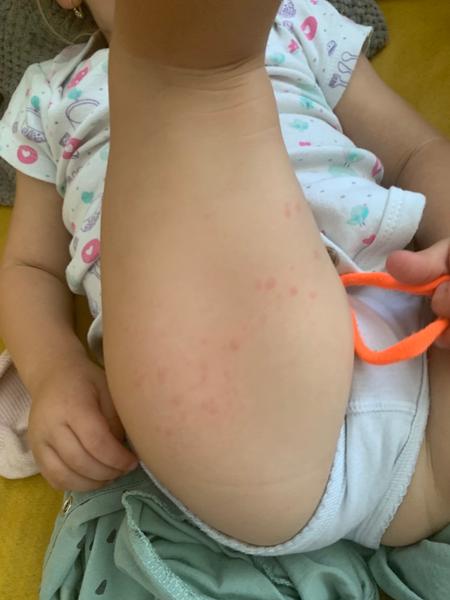 Štípance verzus ekzém