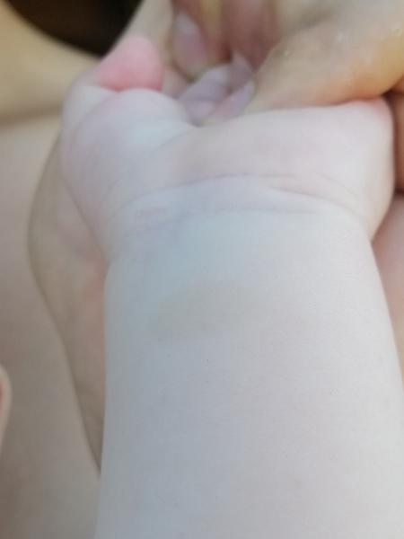 Fľaky po tele u dieťatka