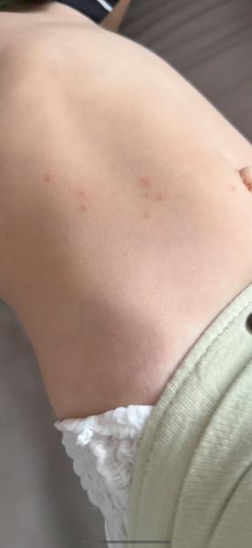 Štipance alebo vyrážky u detí