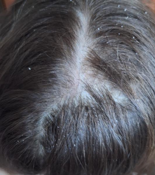 Ako riešiť lupiny u 6,5-ročnej dcéry?