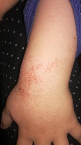 Aké sú toto podľa vás vyrážky?