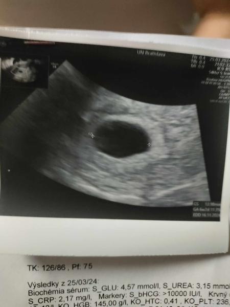 Je normálne mať prázdny gestačný vačok v piatom týždni tehotenstva?