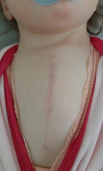 Ako riešiť pectus carinatum po operácii srdiečka?