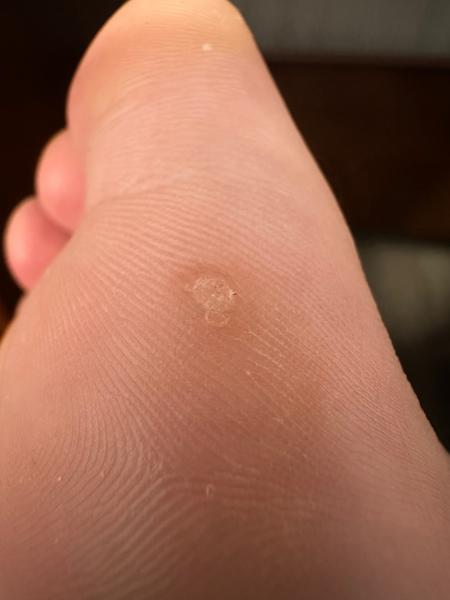 Je to kurie oko alebo bradavica?