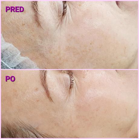 Radiothermolifting - omladenie rádiofrekvenciou, 