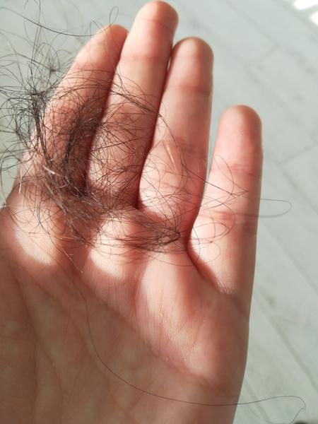 5 mesiacov po pôrode a značné vypadávanie vlasov