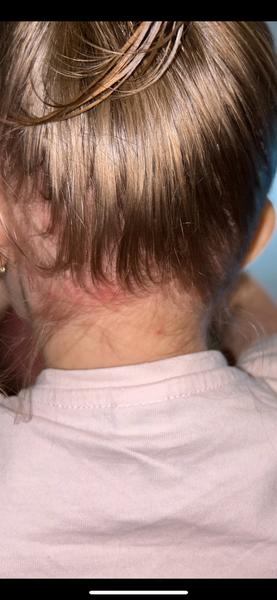 Príčiny vyrážok u 3-ročnej dcérky?