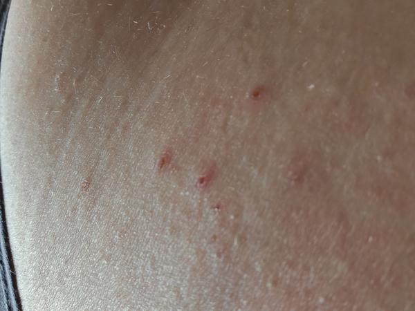 Prečo sa mi objavili tieto vyrážky?