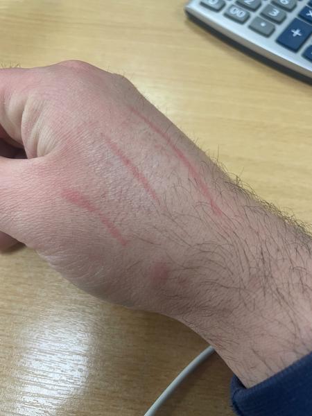 Je to dermografická žihľavka?