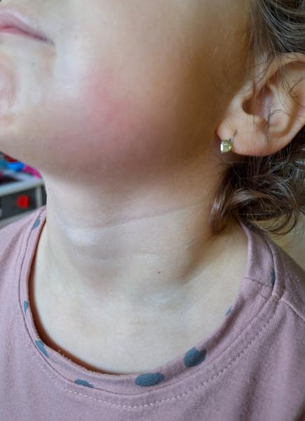 Červený fľak na tvári dieťaťa: Čo to môže byť?