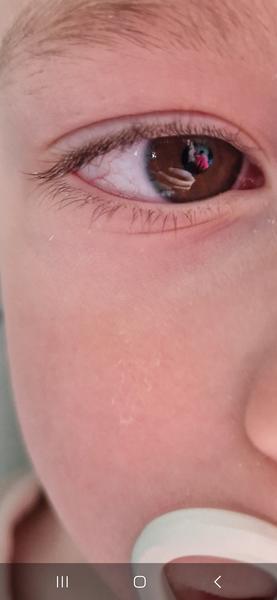 Prečo dieťaťu ostávajú biele škvrny po slzách?