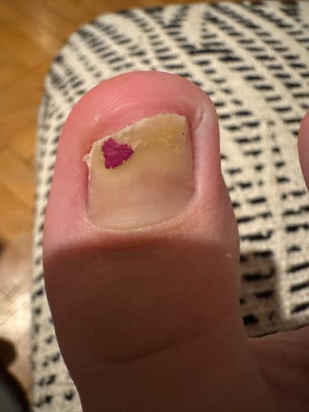 Čo robiť s poškodeným nechtom?