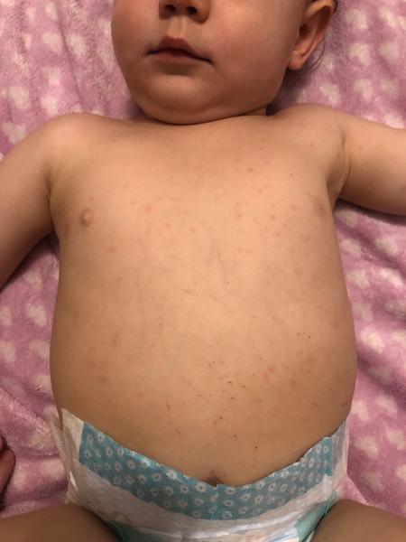 Reakcia po MMR očkovaní