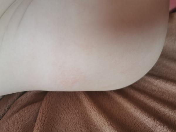 Aké vyrážky má moja dcérka?