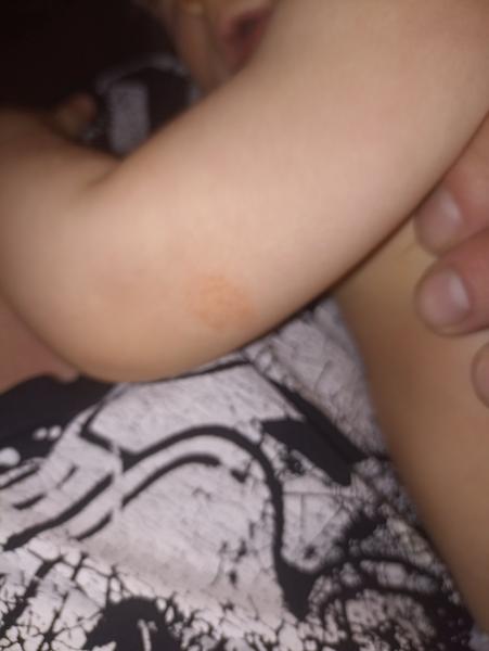 Z čoho môže byť červený suchý fľak u bábätka?