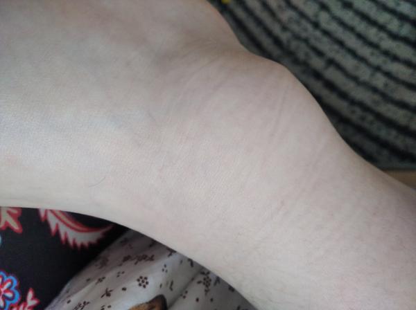 Chlapec spadol a napuchol mu kotník. Máme ísť na urgent?