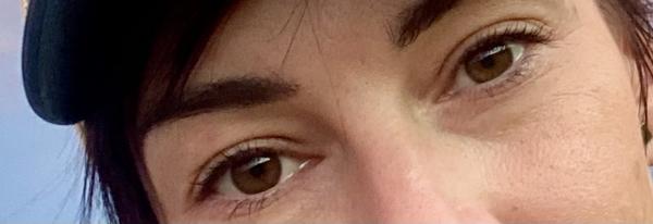 Som už adept na operáciu horných viečok?