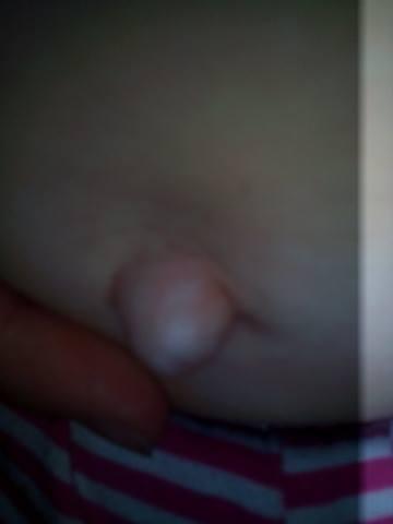 17 mesačnej sa pretrhla brušná dutina a črievko vychádza von 