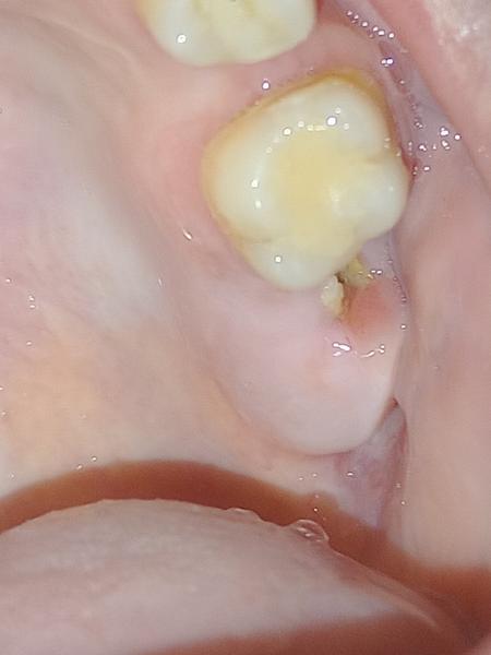 Bolesť päť dní po extrakcii zuba: Je to normálne?