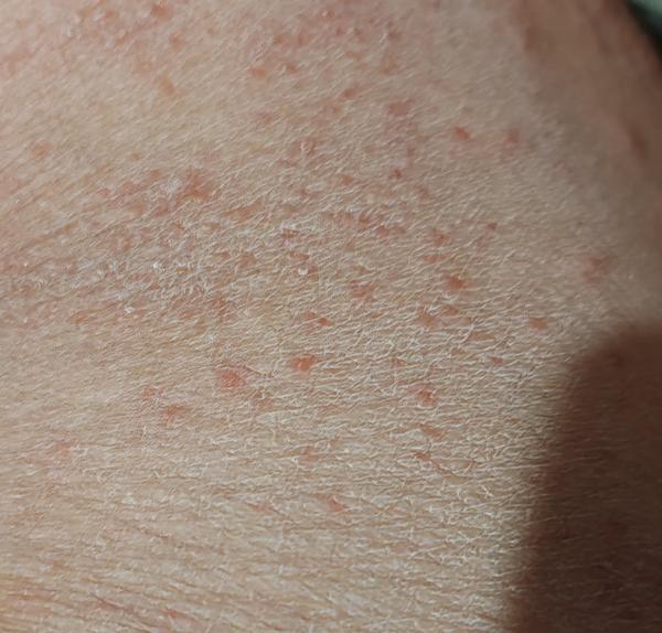 Aké sú tieto svrbiace vyrážky a ako ich liečiť?