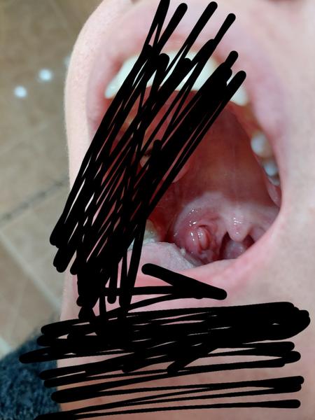 Z čoho mám divný pocit okolo mandli?