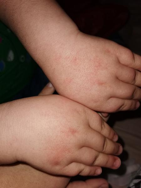 Čo to môže byť na ruke 8-ročnej?