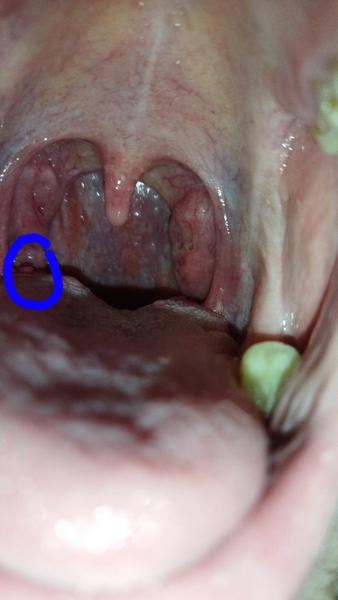Je potrebné riešiť výrastok na jazyku s lekárom?